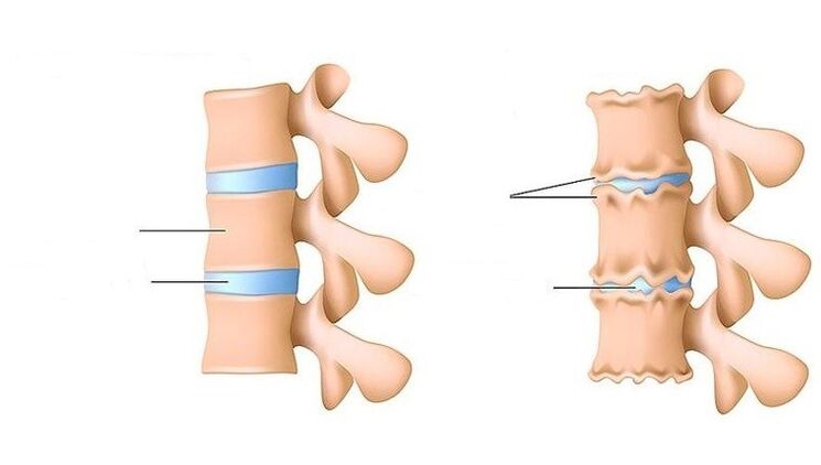 здрав гръбначен стълб и гръбначен стълб, засегнати от остеохондроза