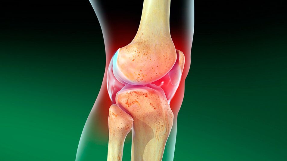 Артроза на колянната става